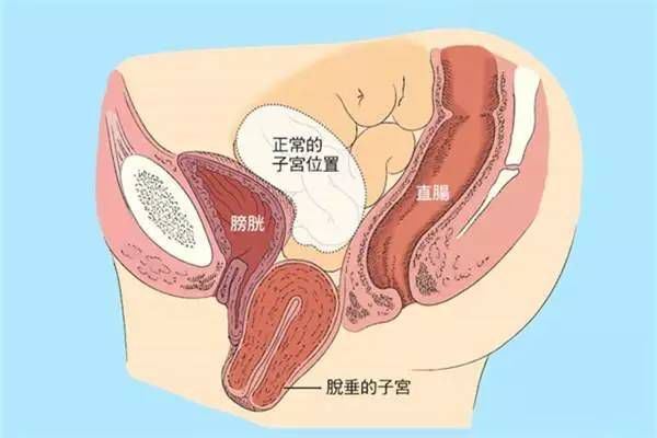 【產(chǎn)后修復(fù)】盆腔臟器脫垂，你有嗎？