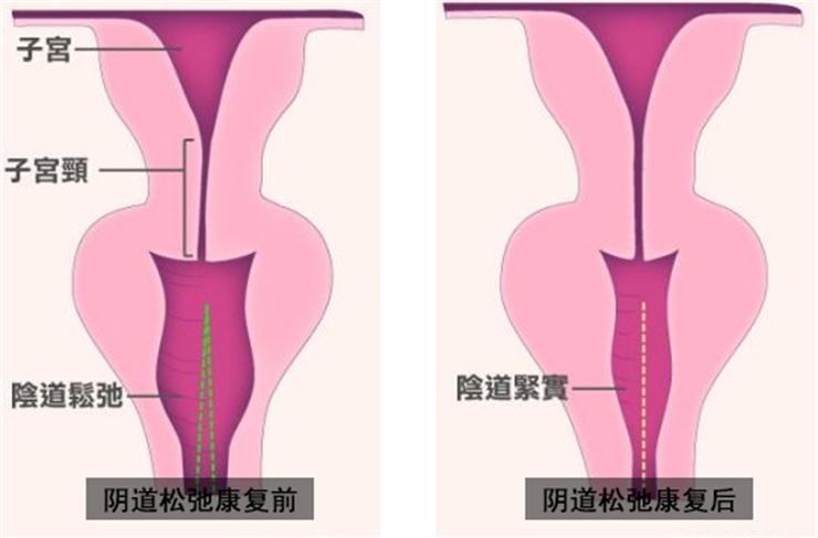 【盆底肌修復】盆底不修復，老來后患無窮