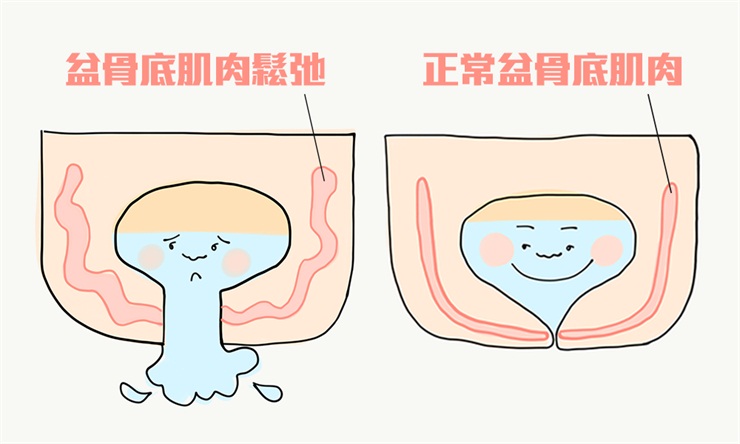 盆底肌康復治療